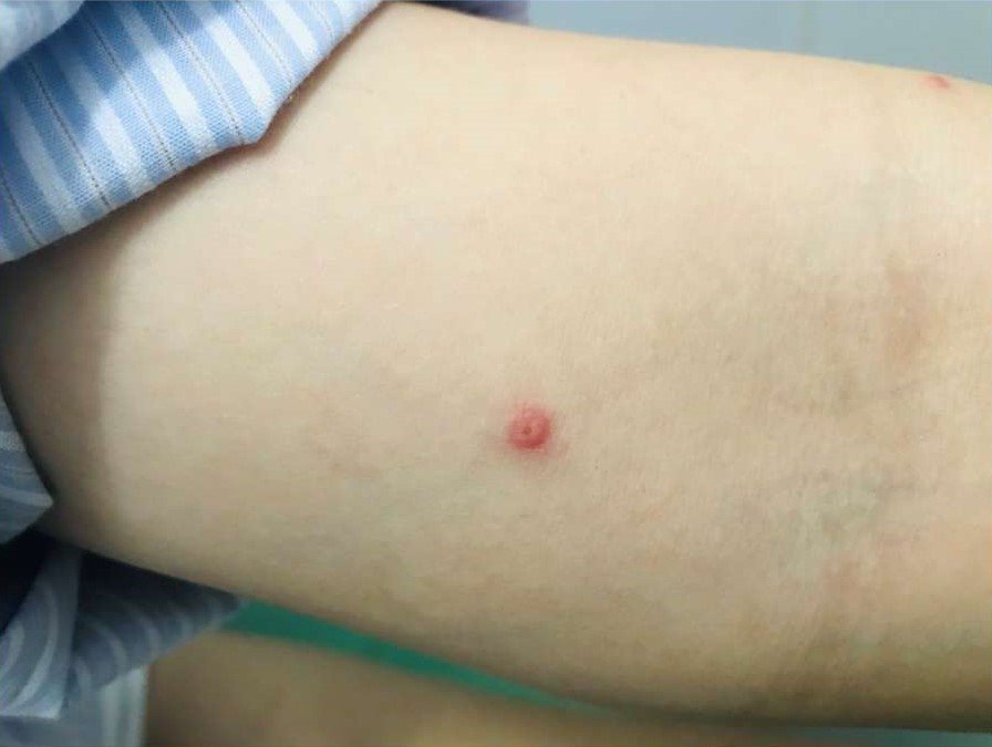 Bóng nước điển hình rải rác các vị trí khác nhau trên cơ thể người bệnh đậu mùa khỉ. 3